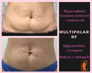 Efekty multipolar RF